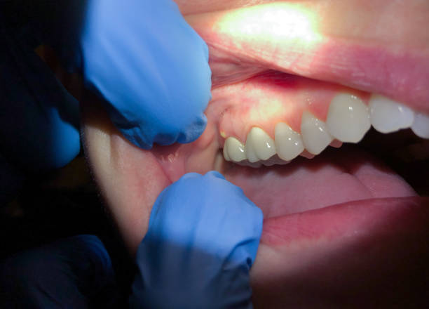 Best Emergency Broken Tooth Repair in West Hurley, NY